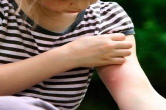 Να τι πρέπει να κάνεις αν τσιμπήσει το παιδί σου μέλισσα