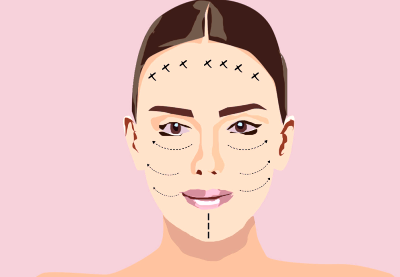 Από ποια ηλικία μπορείς να κάνεις botox προληπτικά