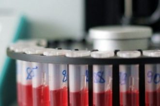 Καρκίνος: Η ομάδα αίματός σας μπορεί να αποκαλύψει εάν διατρέχετε υψηλότερο κίνδυνο