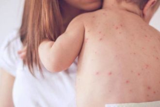 ΗΠΑ: Νεκρό και δεύτερο παιδί από ιλαρά - Ήταν ανεμβολίαστο - Σφοδρές επικρίσεις κατά Κένεντι