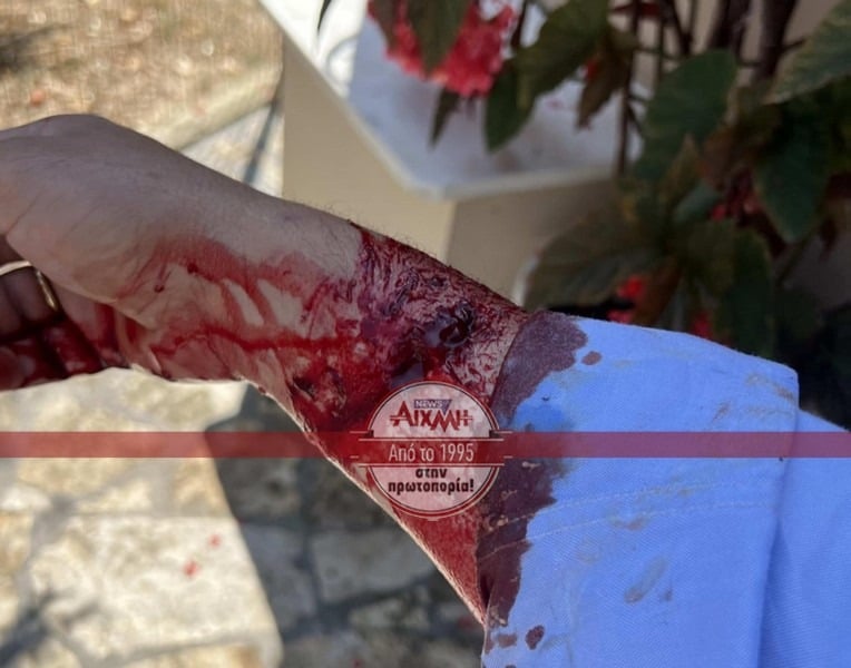 ΠΡΟΣΟΧΗ ΣΚΛΗΡΗ ΕΙΚΟΝΑ: ΔΥΤΙΚΗ ΕΛΛΑΔΑ: Αδέσποτο σκυλί δάγκωσε γνωστό δικηγόρο - Γέμισε αίματα ΠΡΟΣΟΧΗ ΣΚΛΗΡΗ ΕΙΚΟΝΑ: ΔΥΤΙΚΗ ΕΛΛΑΔΑ: Αδέσποτο σκυλί δάγκωσε γνωστό δικηγόρο - Γέμισε αίματα