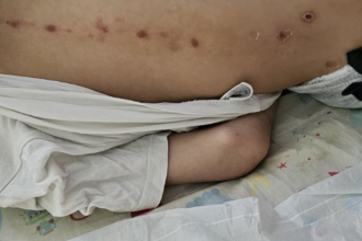 Νέα μαρτυρία για τα σημάδια στην πλάτη του 10χρονου ΑμεΑ στην Πάτρα - «Τα είδαμε εντελώς τυχαία, ζητήσαμε χαρτί από γιατρό»