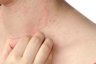Έκζεμα: Πότε φταίνε οι ορμόνες για τις εξάρσεις – Γιατί υποφέρουν περισσότερο οι γυναίκες