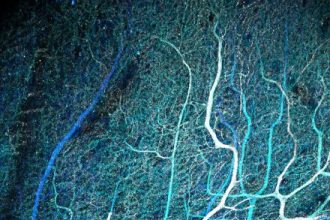 ΠΟΥ: Να ενισχυθεί η αντιμετώπιση των νευρολογικών παθήσεων