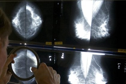 Γιατί όλο και περισσότεροι νέοι άνθρωποι προσβάλλονται από καρκίνο;