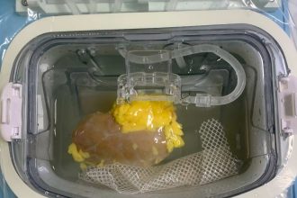 Επιστήμονες μεταμόσχευσαν νεφρό με τροποποιημένη ομάδα αίματος σε εγκεφαλικά νεκρό δέκτη