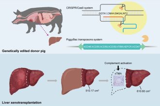 Η πρώτη στον κόσμο μεταμόσχευση ήπατος από χοίρο σε άνθρωπο
