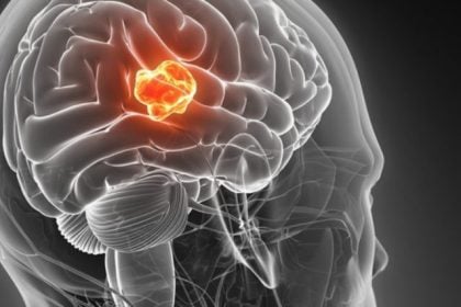 Πρωτοποριακή μέθοδος ενισχύει την ανοσολογική αντίδραση στο γλοιοβλάστωμα