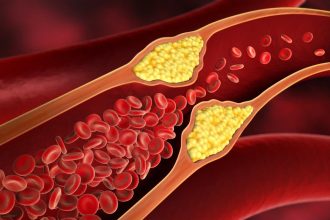 Πειραματικό φάρμακο μειώνει δραστικά την «κακή» χοληστερίνη όταν οι στατίνες «κάνουν πίσω»