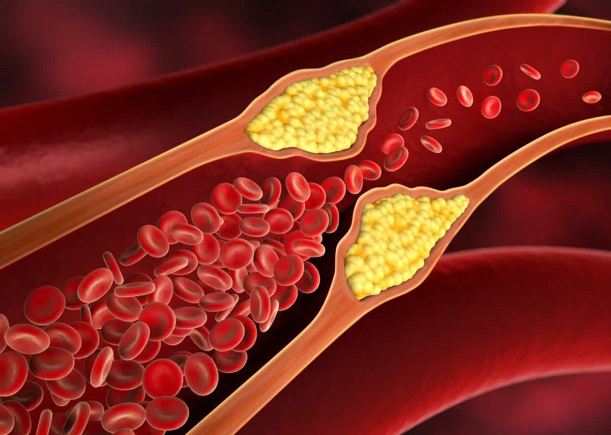 Πειραματικό φάρμακο μειώνει δραστικά την «κακή» χοληστερίνη όταν οι στατίνες «κάνουν πίσω»