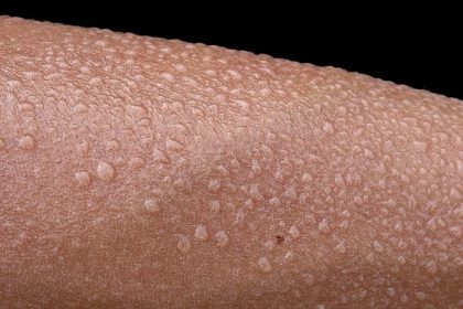 Έξυπνοι αισθητήρες και τεχνητή νοημοσύνη εντοπίζουν πρώιμες ενδείξεις ασθένειας μέσω του ιδρώτα