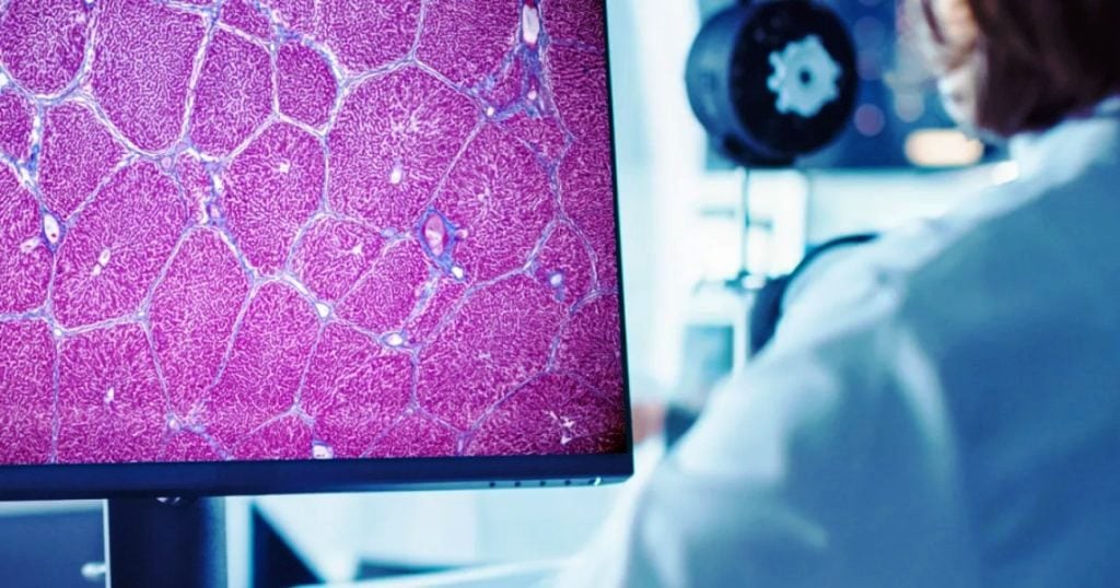 Εγκρίθηκε το πρώτο εργαλείο τεχνητής νοημοσύνης που επιταχύνει τις κλινικές δοκιμές φαρμάκων για ηπατική νόσο