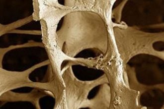 Οστεοπόρωση: Πώς σχετίζεται με το αδυνάτισμα;