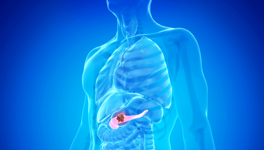 Καρκίνος του παγκρέατος: Πρωτοποριακή έρευνα αποκάλυψε γονιδιακά μοτίβα που σχετίζονται με τη νόσο