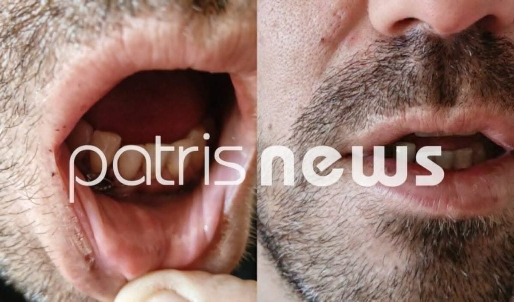 Σοβαρό επεισόδιο με ξυλοδαρμό άνδρα στα κρατητήρια της Διεύθυνσης Αστυνομίας Ηλείας - Μεταφέρθηκε στο ΠΓΝΠ