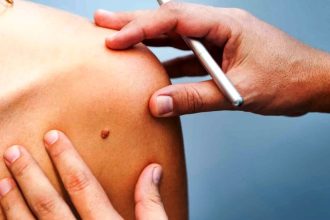 Σχεδόν 4 στους 10 καρκίνους παγκοσμίως θα μπορούσαν να είχαν προληφθεί