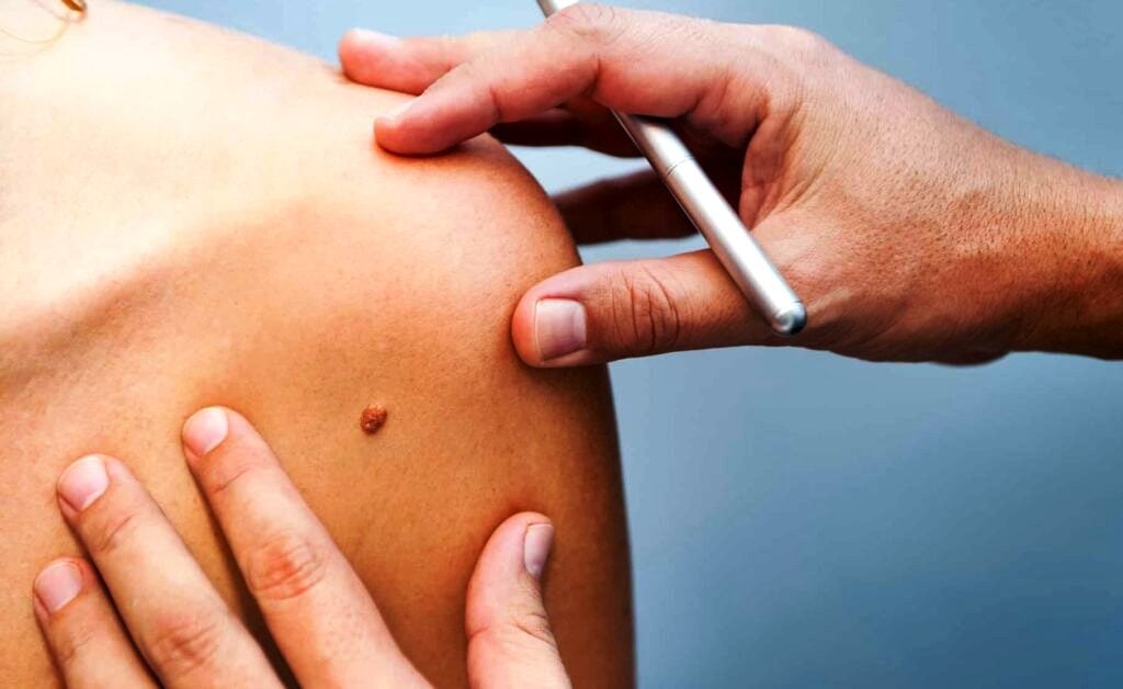 Σχεδόν 4 στους 10 καρκίνους παγκοσμίως θα μπορούσαν να είχαν προληφθεί